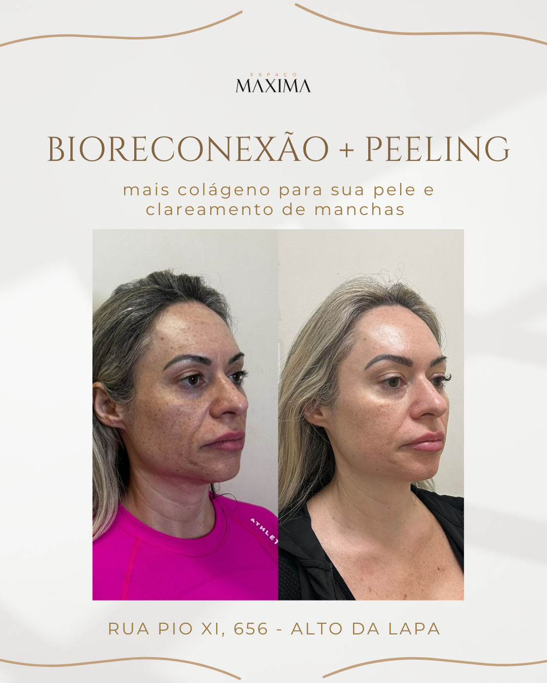 antes e depois tratamento com peeling quimico e bioestimuladores